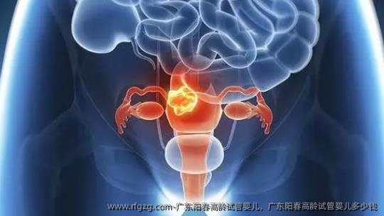 广东阳春高龄试管婴儿，广东阳春高龄试管婴儿多少钱