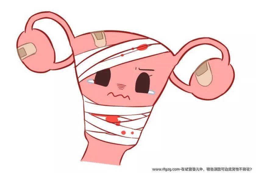 在试管婴儿中，哪些原因可造成男性不育呢？
