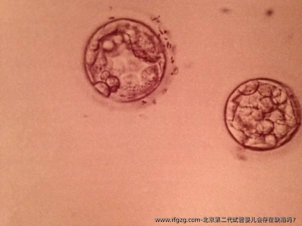北京第二代试管婴儿会存在缺陷吗？