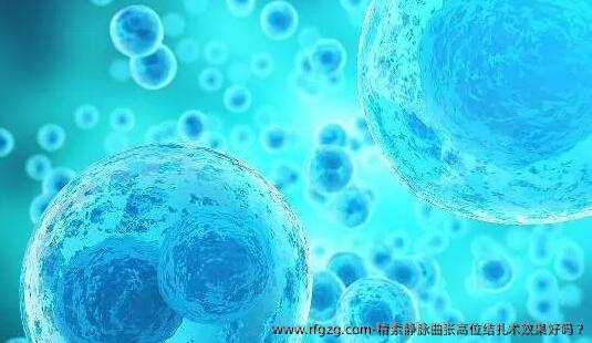 精索静脉曲张高位结扎术效果好吗 ?