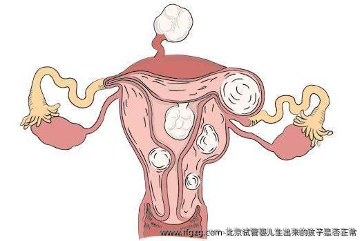 北京试管婴儿生出来的孩子是否正常