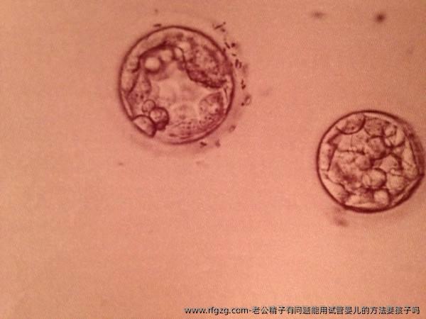 老公精子有问题能用试管婴儿的方法要孩子吗