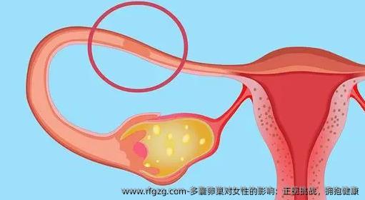 多囊卵巢对女性的影响：正视挑战，拥抱健康
