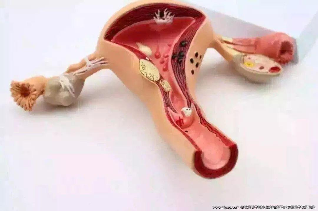 做试管卵子能冷冻吗?试管可以先卵泡取出子冻起来吗？