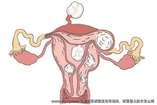 马来西亚试管成功率高吗，试管婴儿技术怎么样