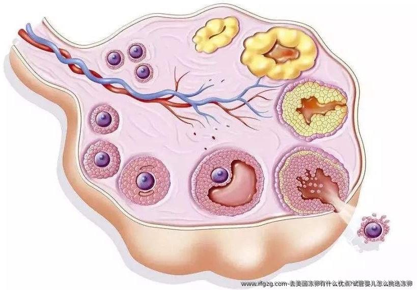 去美国雪藏卵有什么优点?试管婴儿怎么挑选雪藏卵