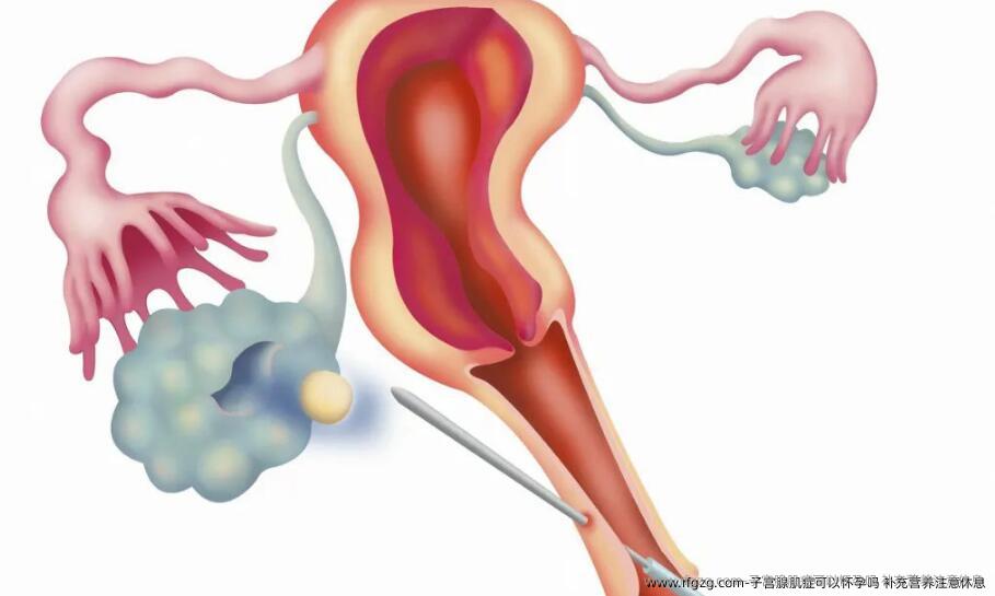 子宫腺肌症可以怀孕吗？补充营养注意休息