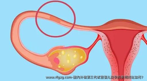 国内外做第三代试管婴儿助孕的费用对比如何？