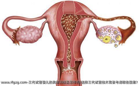 三代试管婴儿的具体流程是怎样的?选择三代试管技术需要考虑哪些因素?
