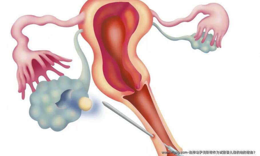 选择哈萨克斯坦作为试管婴儿目的地的理由？
