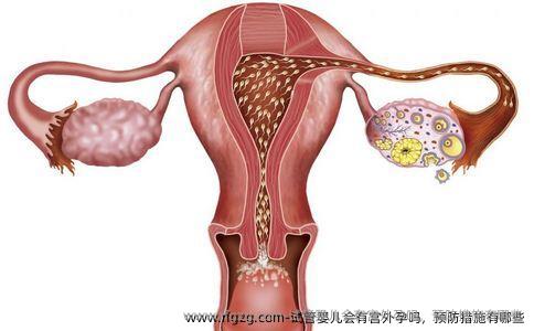 试管婴儿会有宫外孕吗，预防措施有哪些